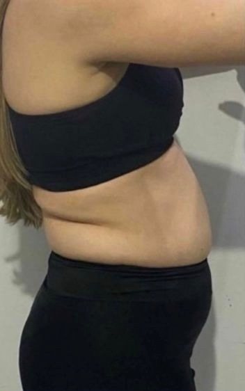 Antes do método hipopressivo